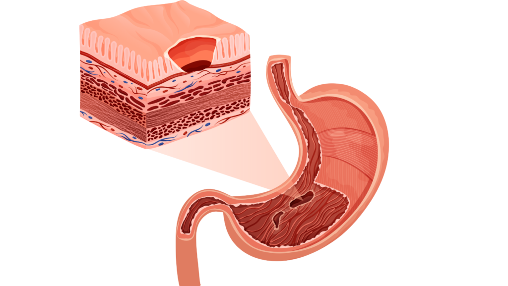 úlcera gástrica, dor abdominal, úlcera