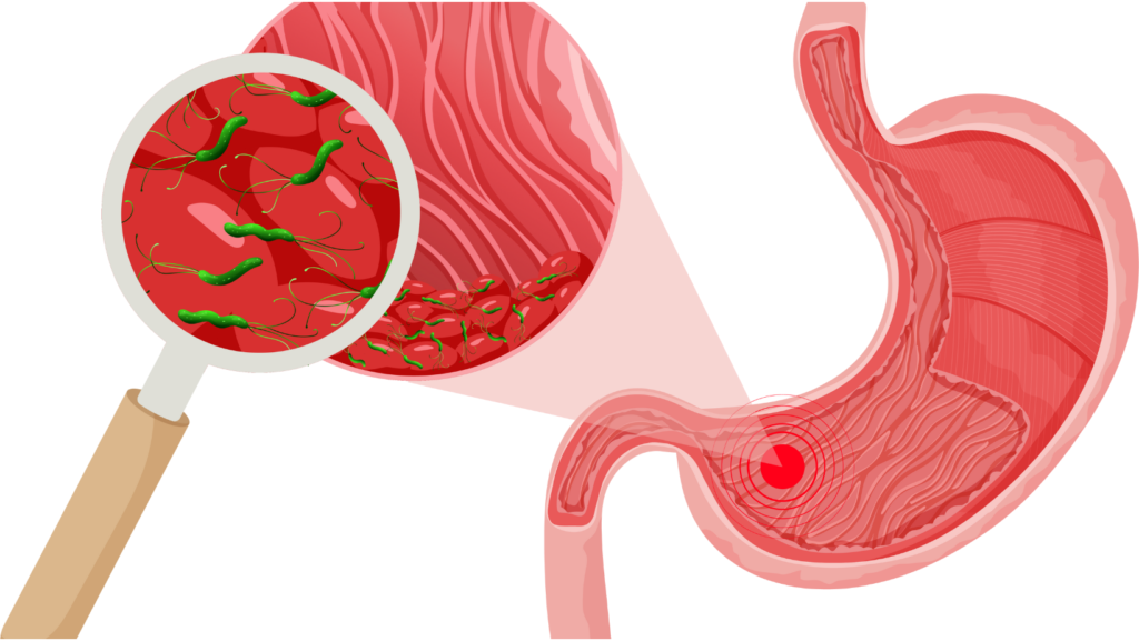 Helicobacter Pylori
H pylori