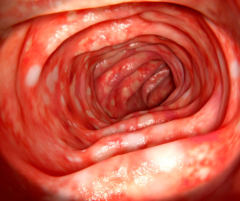 retocolite ulcerativa
colite
diarreia 
diarreia com sangue