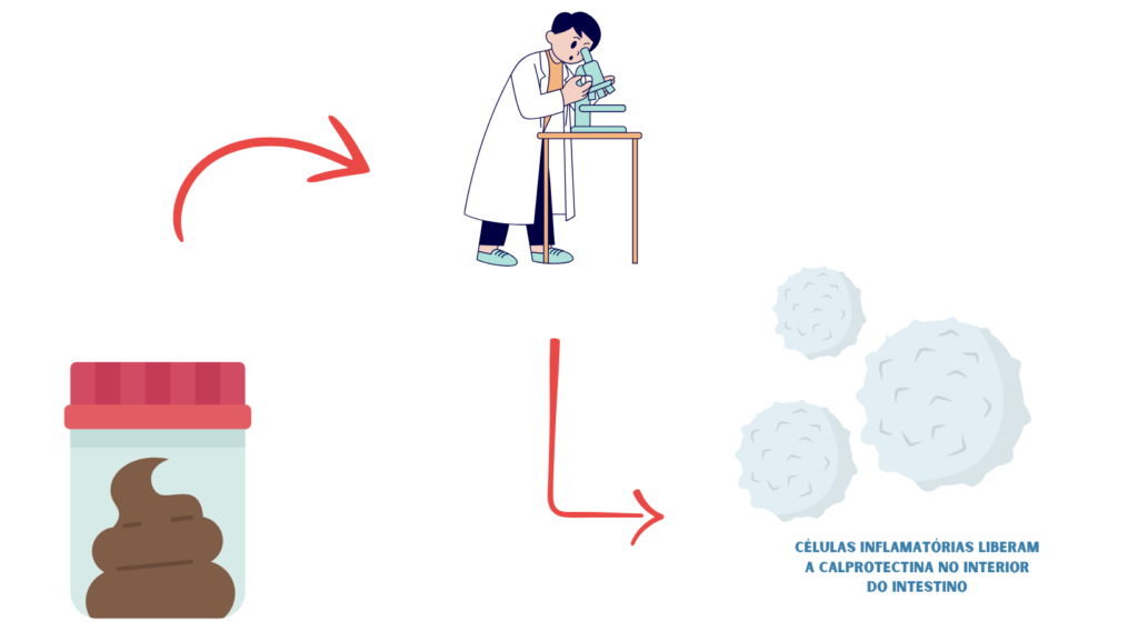 calprotectina
doença inflamatória intestinal
calprotectina alterada
o que pode ser?