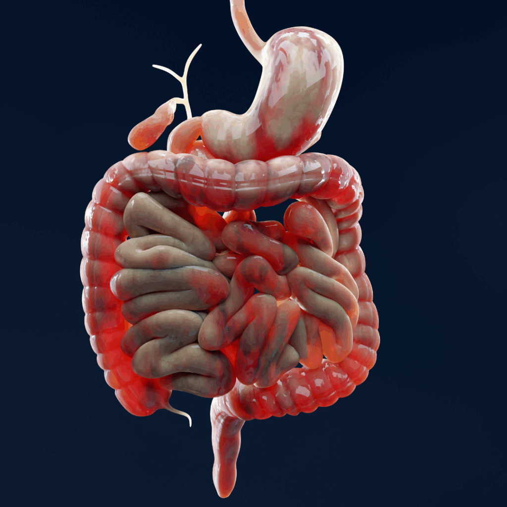 doenças inflamatórias intestinais
doença de crohn
retocolite ulcerativa
diarreia